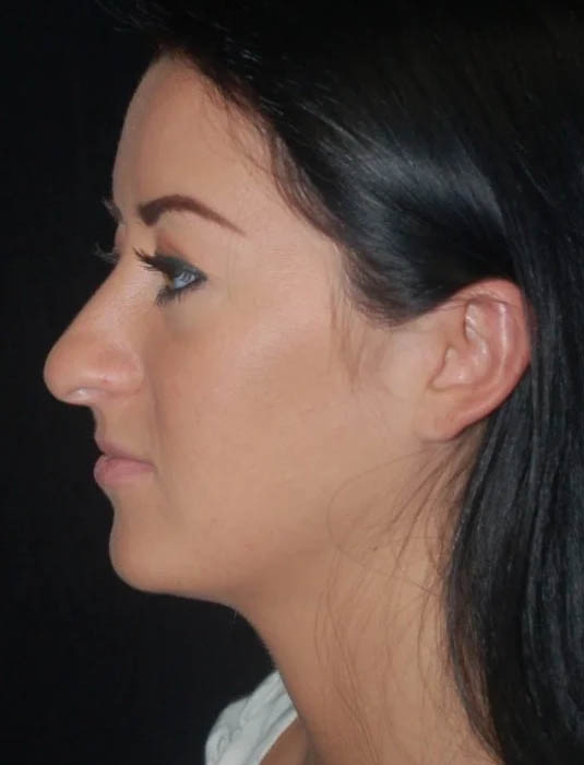 Facial Fat Grafting case #4576