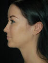 Facial Fat Grafting case #4576