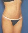 Liposuction case #4743