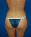 Liposuction case #4750