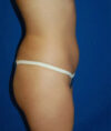 Liposuction case #4750