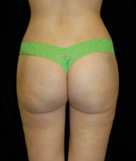 Liposuction case #4771