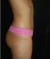 Liposuction case #4785