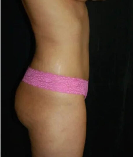 Liposuction case #4785