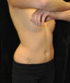 Liposuction case #4792