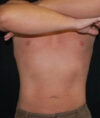 Liposuction case #4797