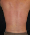 Liposuction case #4797