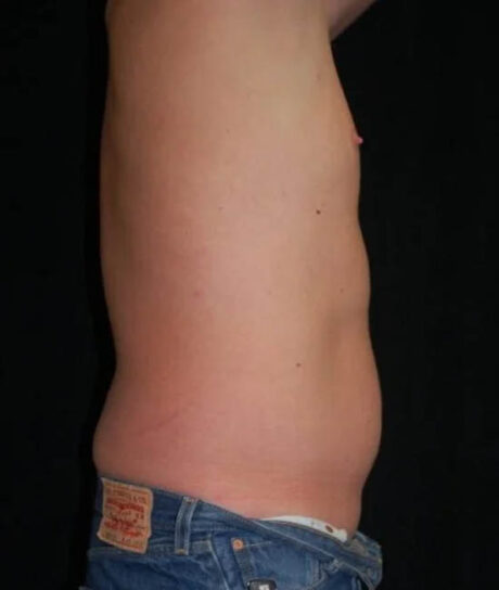 Liposuction case #4797