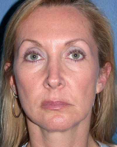 Facelift case #4369