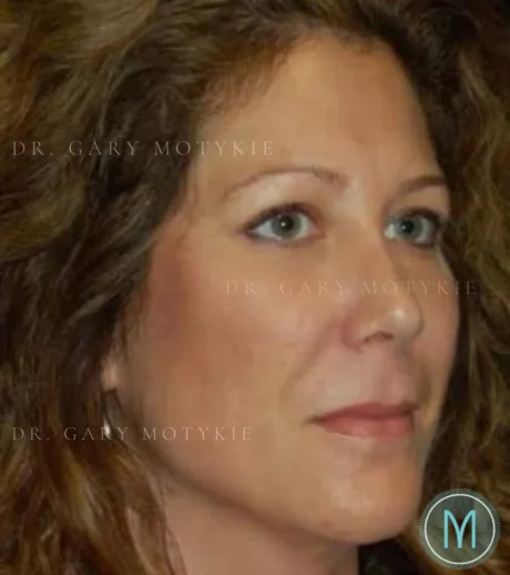 Lower Blepharoplasty case #3454