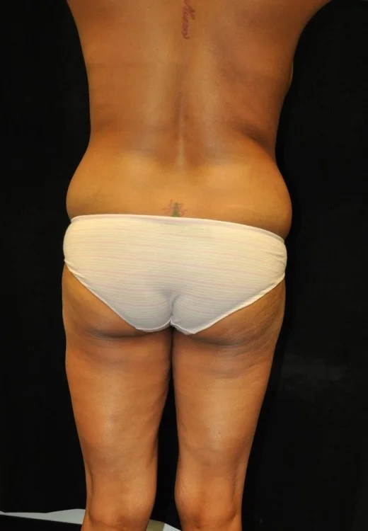 Brazilian Butt Lift case #3589