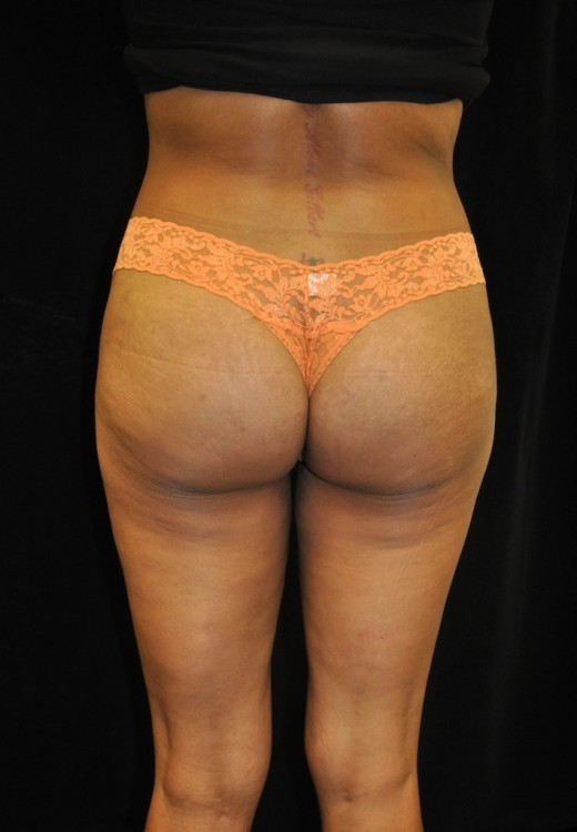 Brazilian Butt Lift case #3589