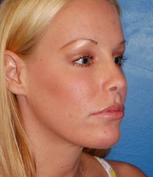 Revision Rhinoplasty case #13387