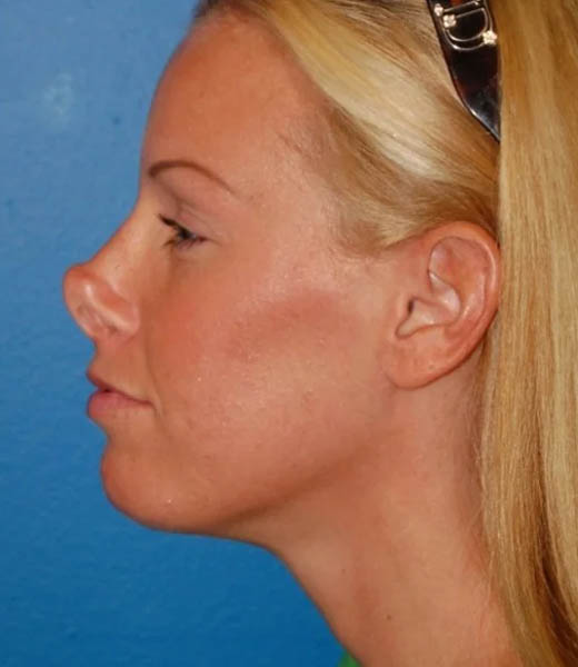 Revision Rhinoplasty case #13387