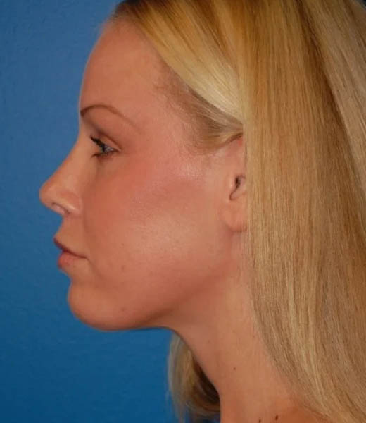 Revision Rhinoplasty case #13387