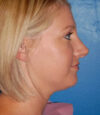 Revision Rhinoplasty case #13397