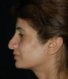 Revision Rhinoplasty case #13402