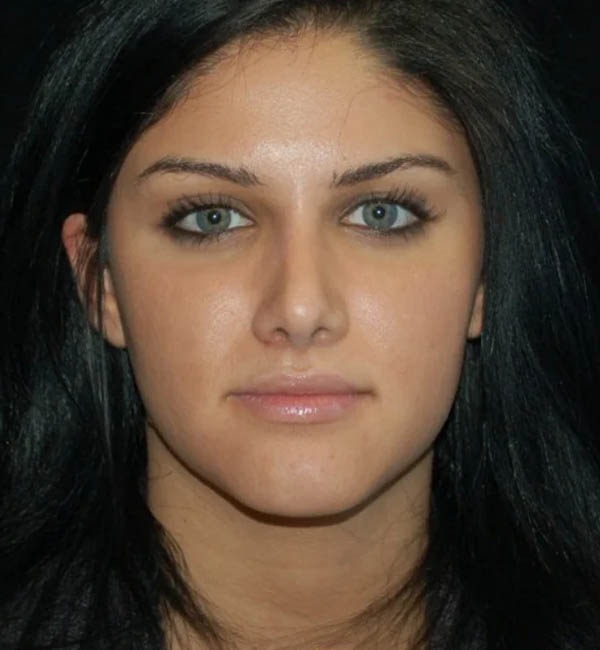 Rhinoplasty case #12761