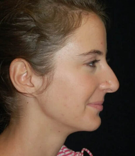 Revision Rhinoplasty case #13409