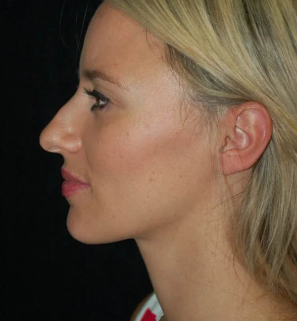 Rhinoplasty case #12768