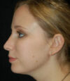 Revision Rhinoplasty case #13416