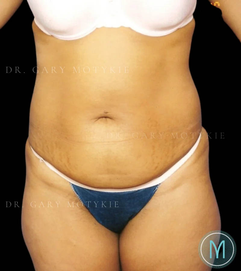 Tummy Tuck case #13533