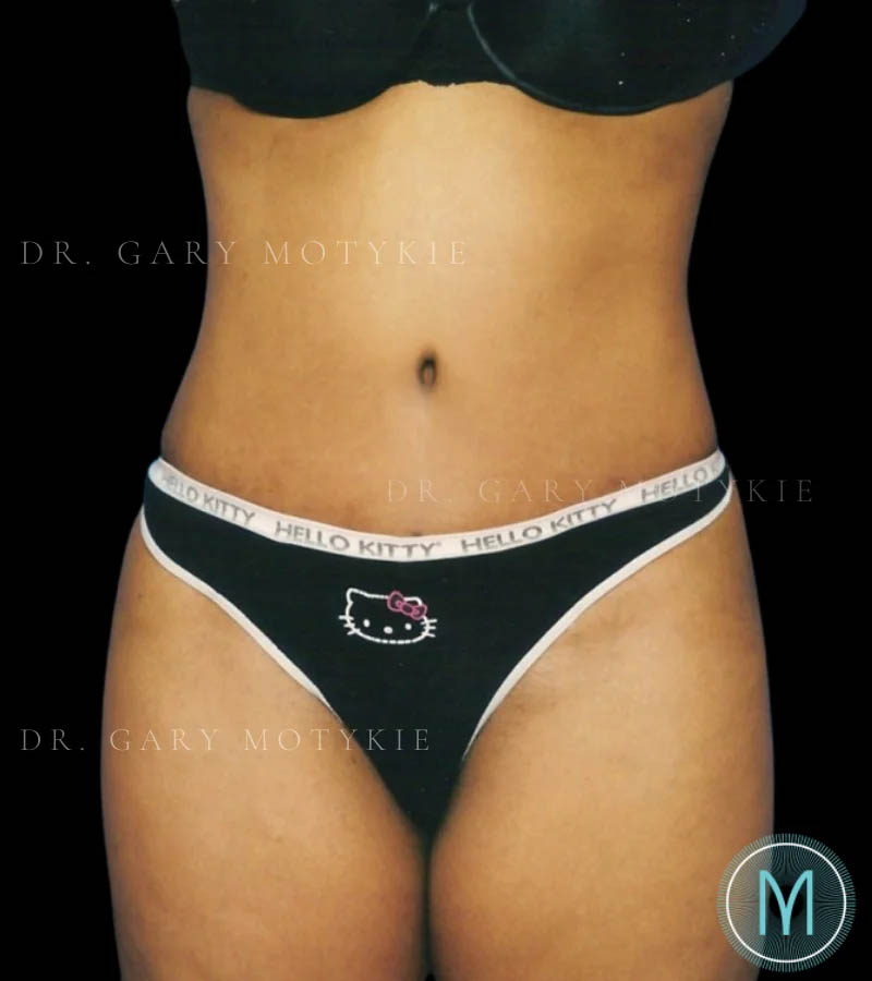 Tummy Tuck case #13533