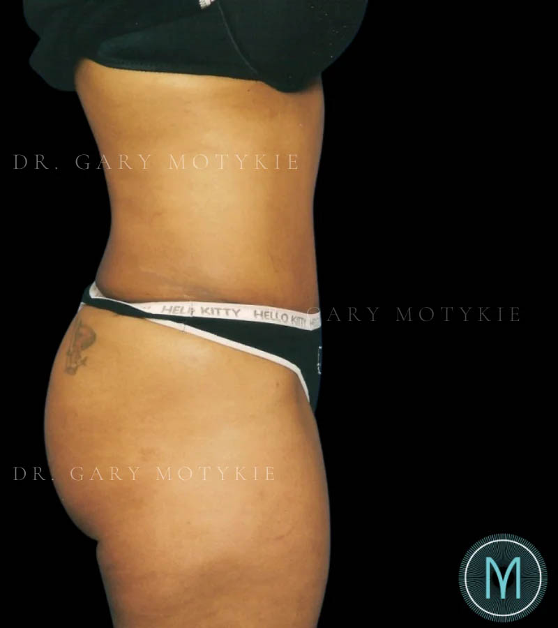 Tummy Tuck case #13533