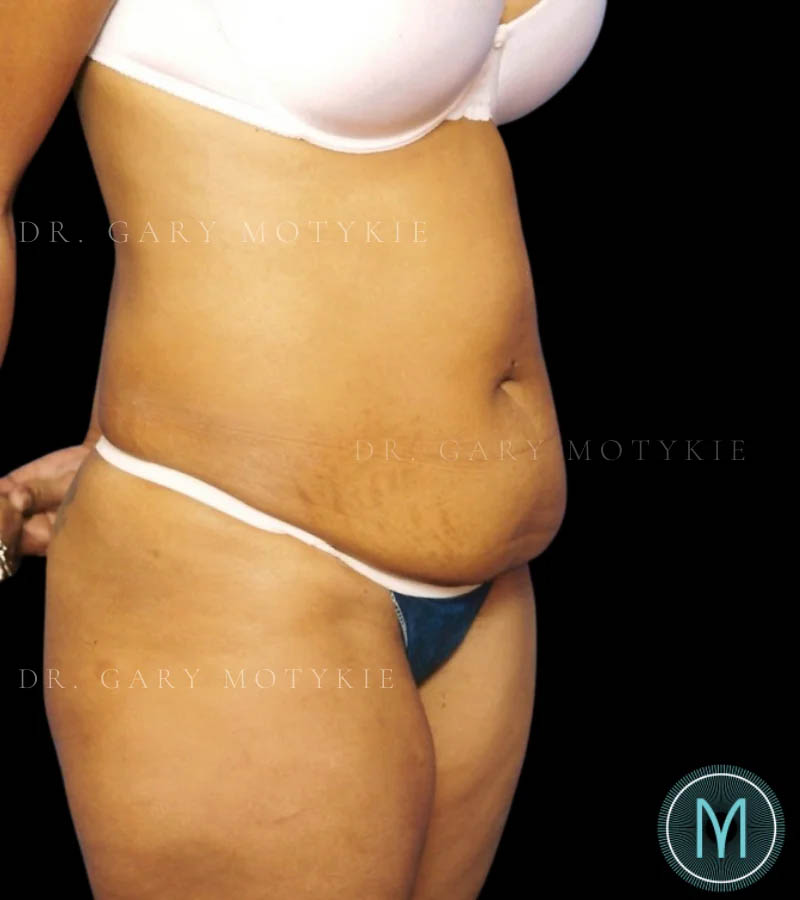 Tummy Tuck case #13533