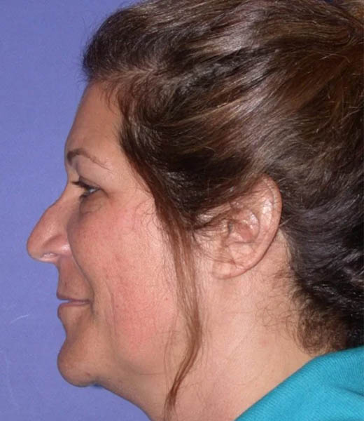 Revision Rhinoplasty case #13423