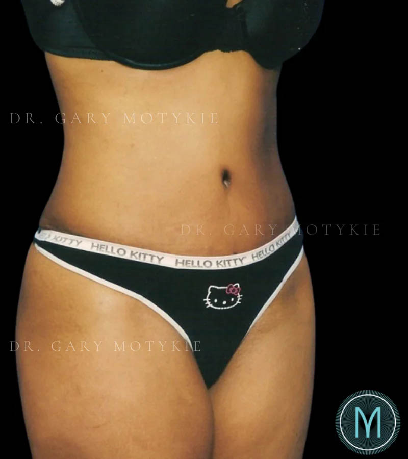 Tummy Tuck case #13533