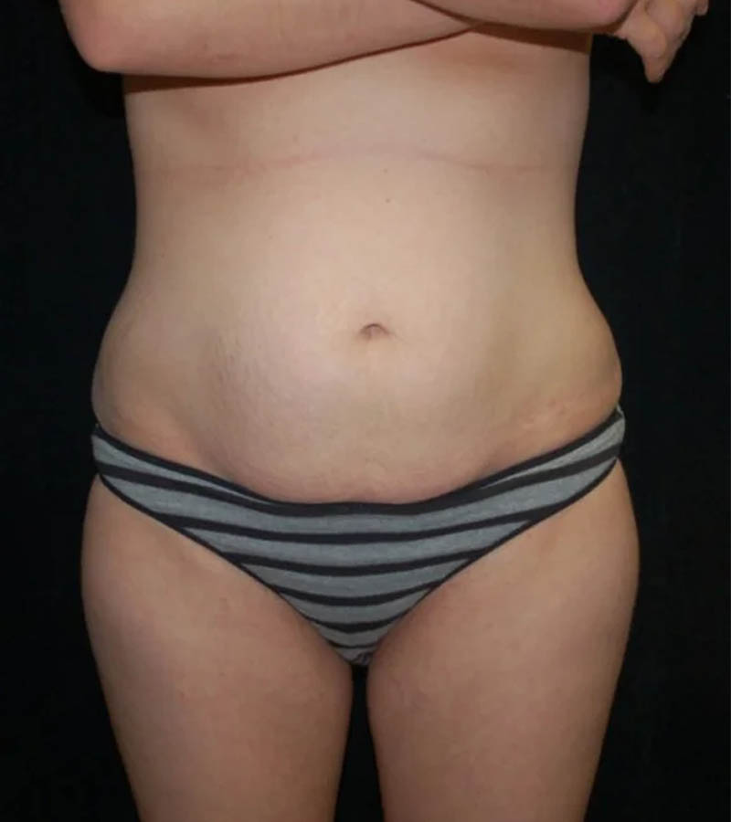 _0036_case-7-10-tummy-tuck-view-1-1.webp