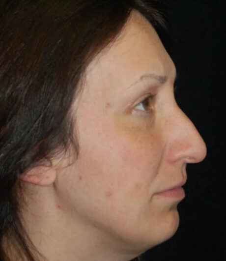 Revision Rhinoplasty case #13433