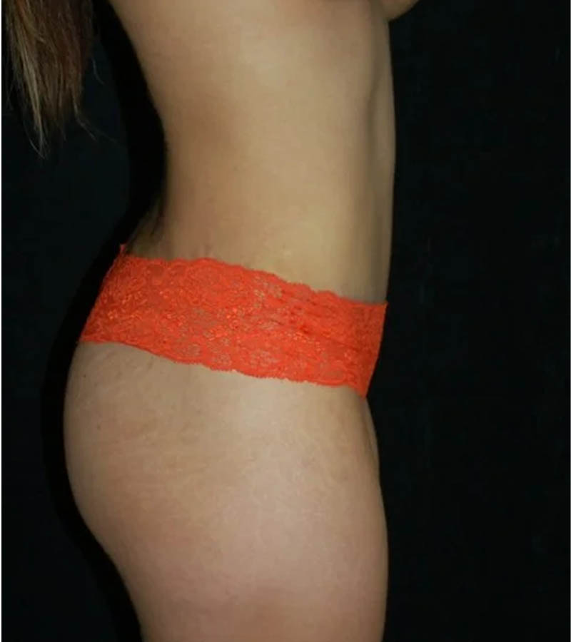 Tummy Tuck case #13554