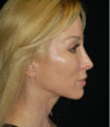 Revision Rhinoplasty case #13447