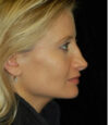 Revision Rhinoplasty case #13450