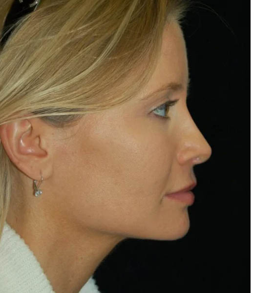 _0057_case-12-2-rhinoplasty-revision-view-1-2.webp