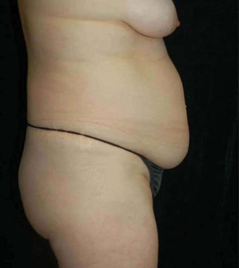 Tummy Tuck case #13568