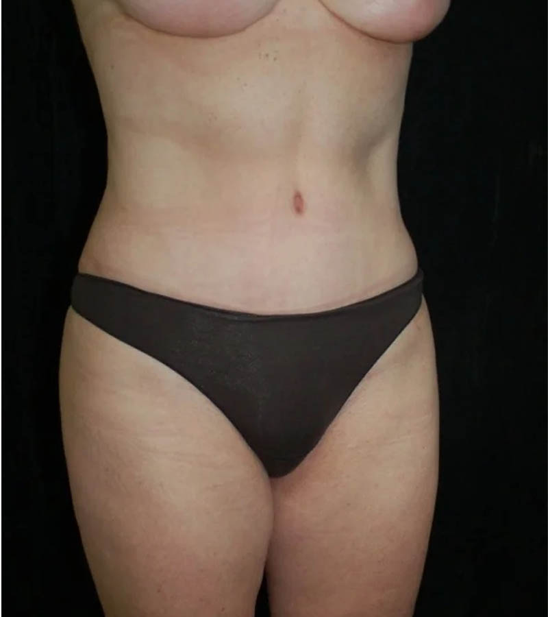 Tummy Tuck case #13568