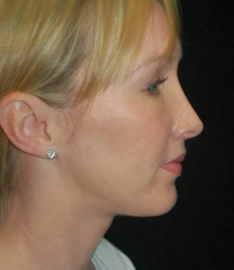 Revision Rhinoplasty case #13456