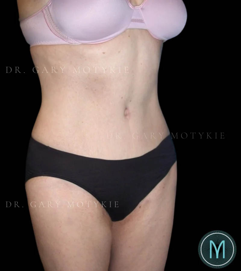 Tummy Tuck case #13580