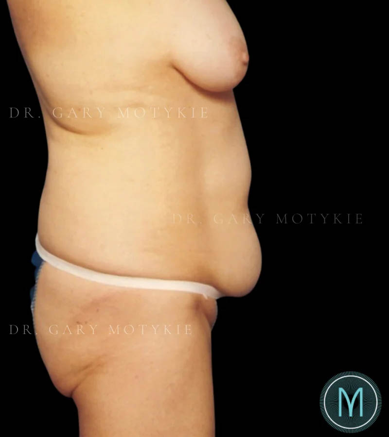 Tummy Tuck case #13580