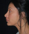 Revision Rhinoplasty case #13468