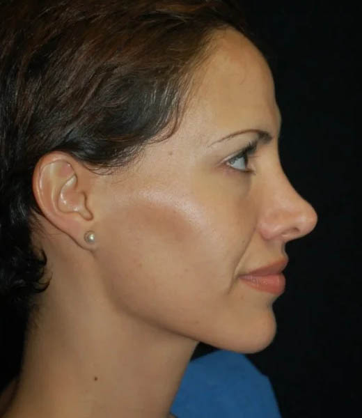 _0078_case-17-rhinoplasty-revision-view-2-1.webp