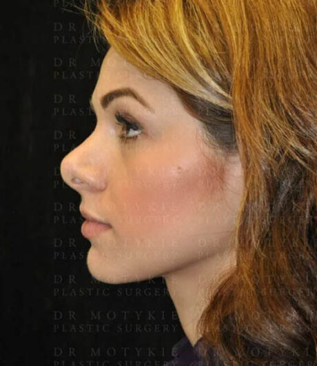 Revision Rhinoplasty case #13493