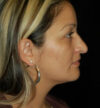 Rhinoplasty case #12889