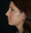 Rhinoplasty case #12895