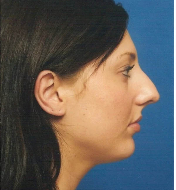 Rhinoplasty case #12902