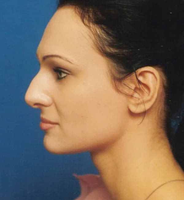 Rhinoplasty case #13097