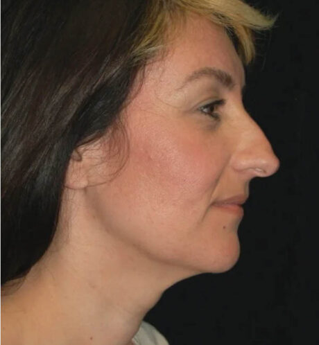 Rhinoplasty case #13074